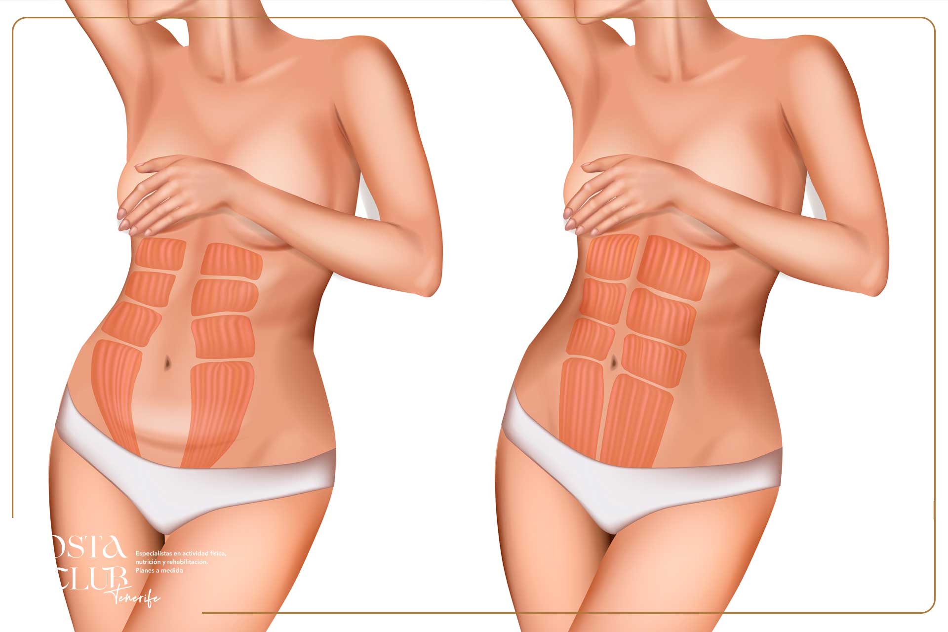 Diástasis abdominal